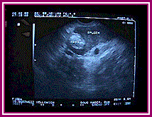 splenictumor.gif (13523 bytes)