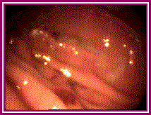 ulcer.gif (14951 bytes)